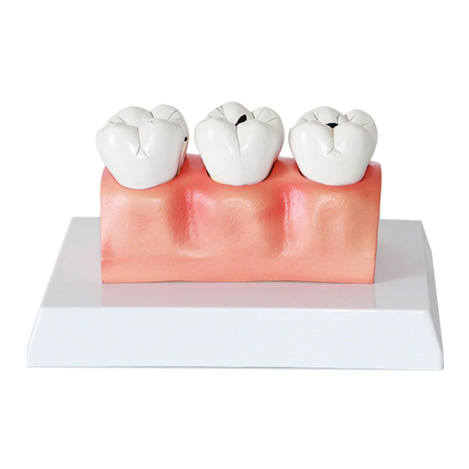 Modelli di comparazione della Carie 4 Volte Modello di decomposizione della Carie Denti sezionati Modello per la Ricerca didattica Modello di Studio per Studenti di odontoiatria