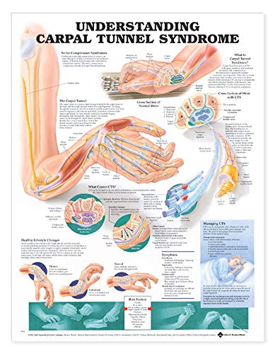Image of Understanding Carpal Tunnel Syndrome Anatomical Chart