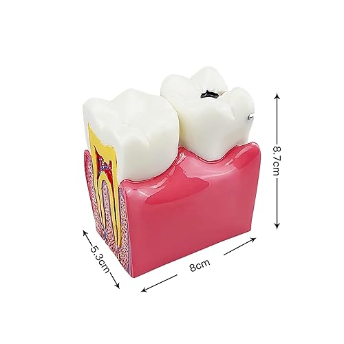Miniatura 3 de youya Dental Dental Dientes Modelo 6veces Caries Dental Dientes Modelo Para comparation estudio y educación del paciente
