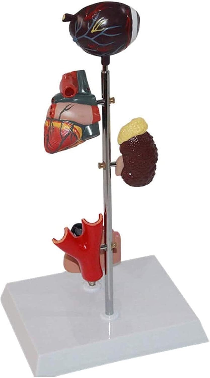 Modèle d'organe du diabète - Modèle d'anatomie médicale Modèle de diabète - Modèle Scientifique d'anatomie Humaine Amovible - for l'éducation et la Formation médicales