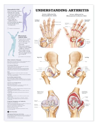 Image of Understanding Arthritis Anatomical Chart