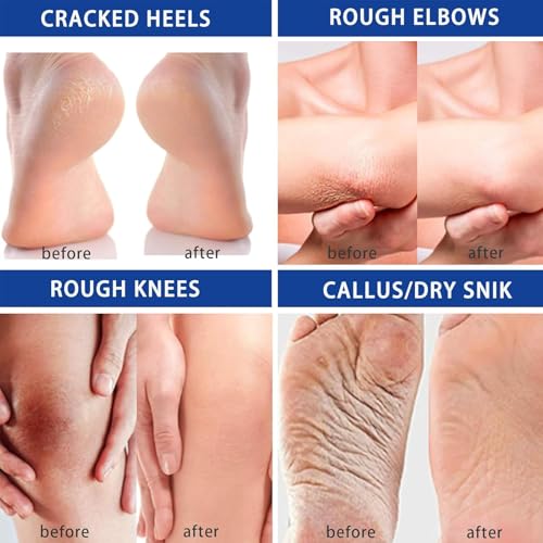 2PCS Urea Foot Cream - Urea Cream 60% for Feet & Dry Cracked Skin - Cracked Heel Repair Cream - Moisturizing Foot & Hand Balm, Urea Moisturiser For Hand Foot Care - Image 5