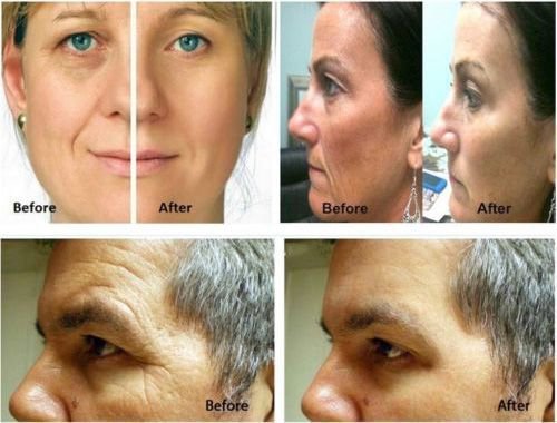 Fantastico Miracle Ceferulichyaluronic Ialuronico