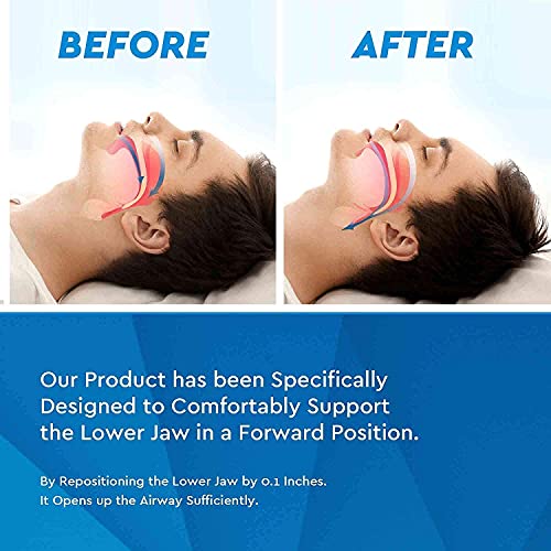 NEOMEN-New-Snore-Stopper-Stop-Snoring-Mouthpiece-Effective-Snoring-Solution-Device-For-Your-Sleep