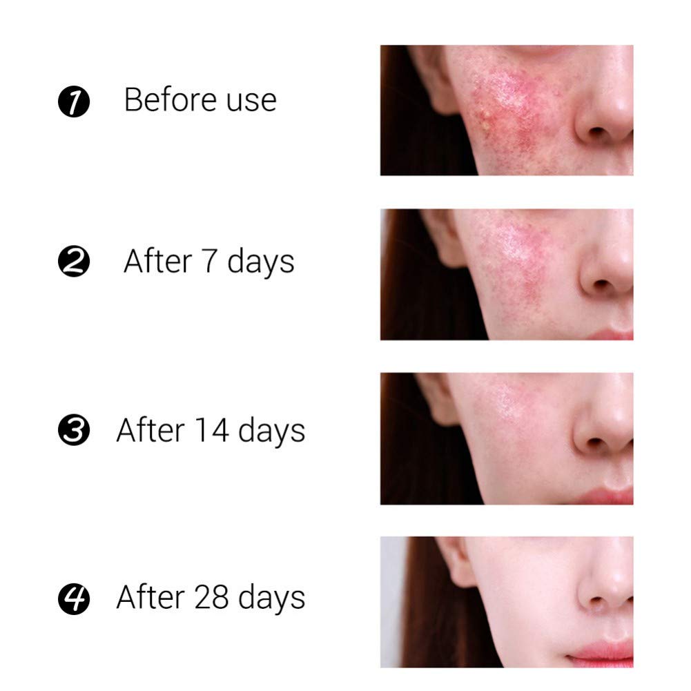 Reparación del acné cicatrices Crema antiacné facial Crema antiacné Crema antiacné Pimple Oil Control Reencoger los poros Sérum Hidratante para la cara