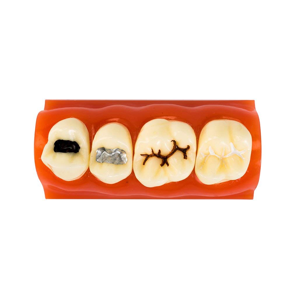 Modello di denti dentali per allenamento orale, chiusura a fessura e scanalatura, strumento educativo per anatomia umana, studio medico e simulatore di pratica