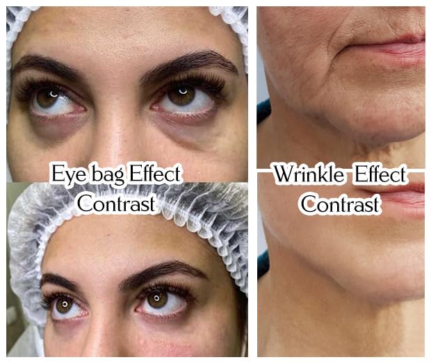 Miniatura 4 de MOIRA - Kit de elevación de hilos PDO para el Día de la Madre, 40 piezas, conjunto de levantamiento de cuerpo entero, tipo liso monotornillo,