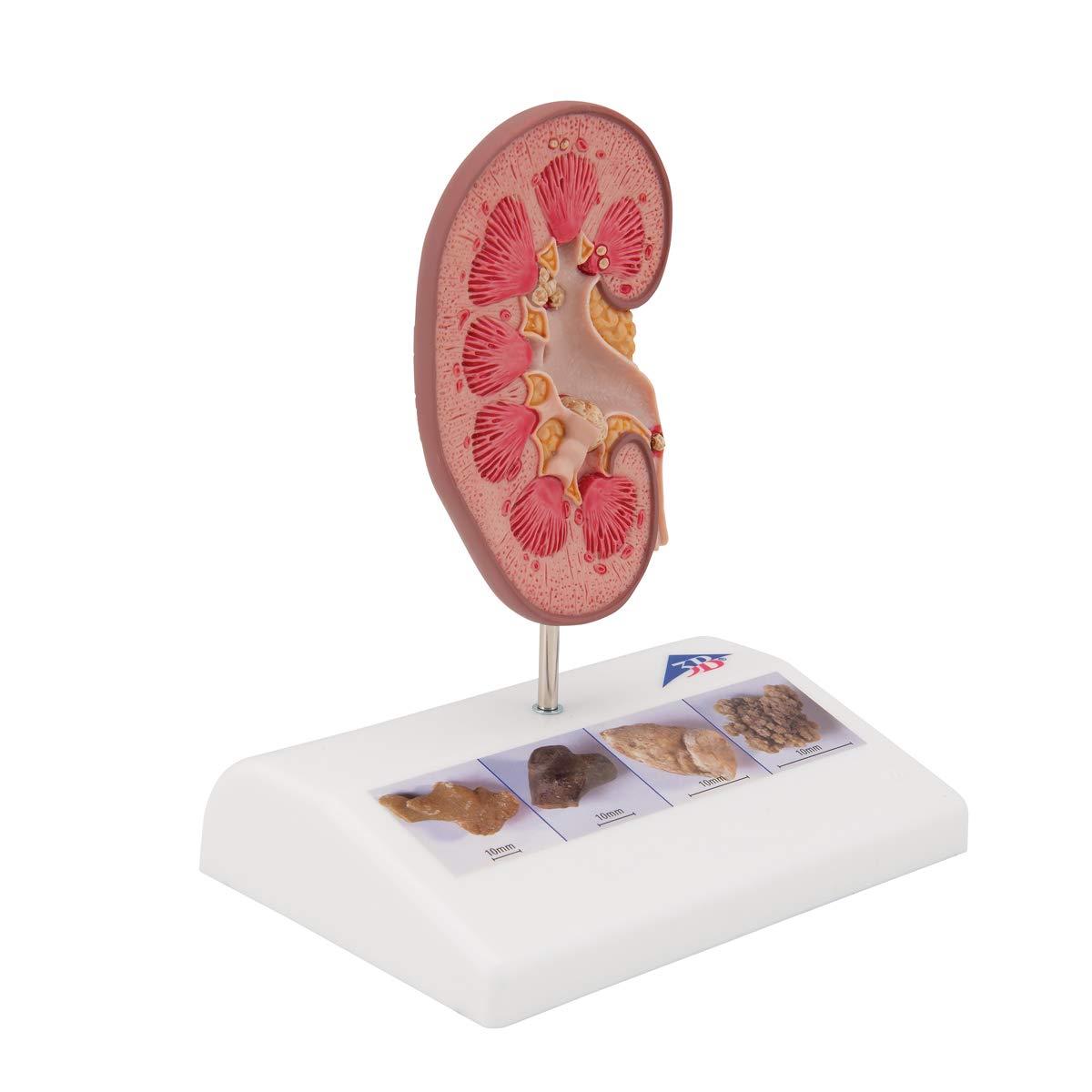 3B Scientific Anatomia ludzka - model z kamienia nerkowego + bezpłatne oprogramowanie anatomiczne - 3B Smart Anatomy, K29