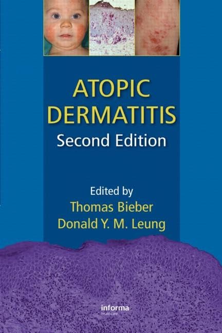 Atopic Dermatitis