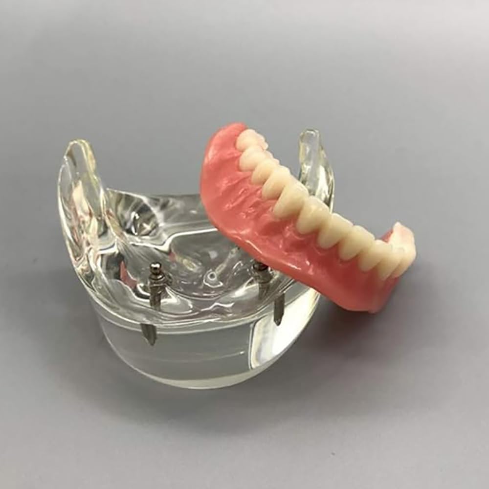 Modelo Dental - Modelo de Dientes de Implantes Dentales- Sobredentadura Dental Mandibular Inferior 2 Implantes Demo para Enseñar y Estudiar