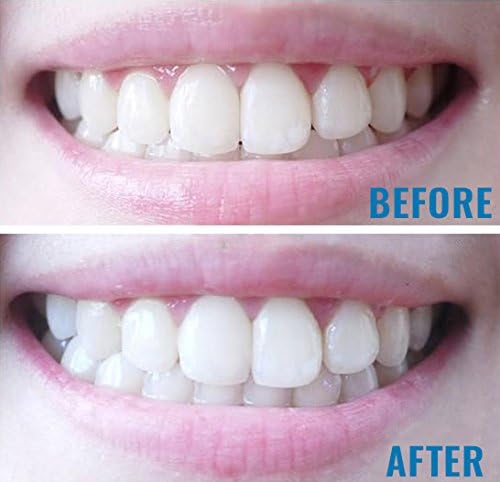 Crystal Whites X6 Platinum Teeth Whitening Kit with LED Lazer Light