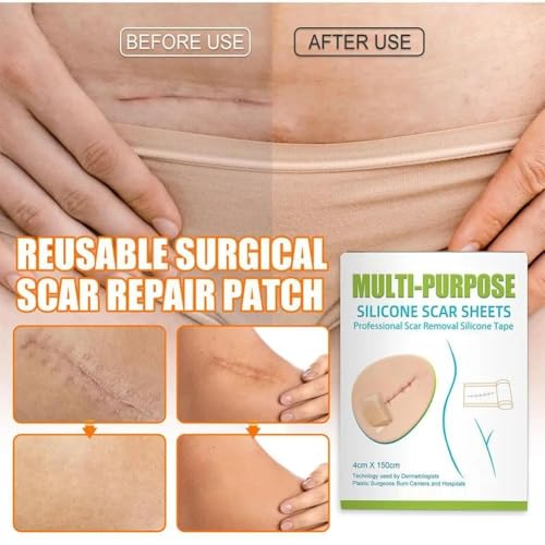 Image of VELOMIX Multipurpose Silicone Scar Sheets, Silicon gel sheets for Scars,Silicone Gel Tape for Scar Removal, Professional Scar Removal Sheets for C-Section, Surgery, Burn Protein (pack of 1)
