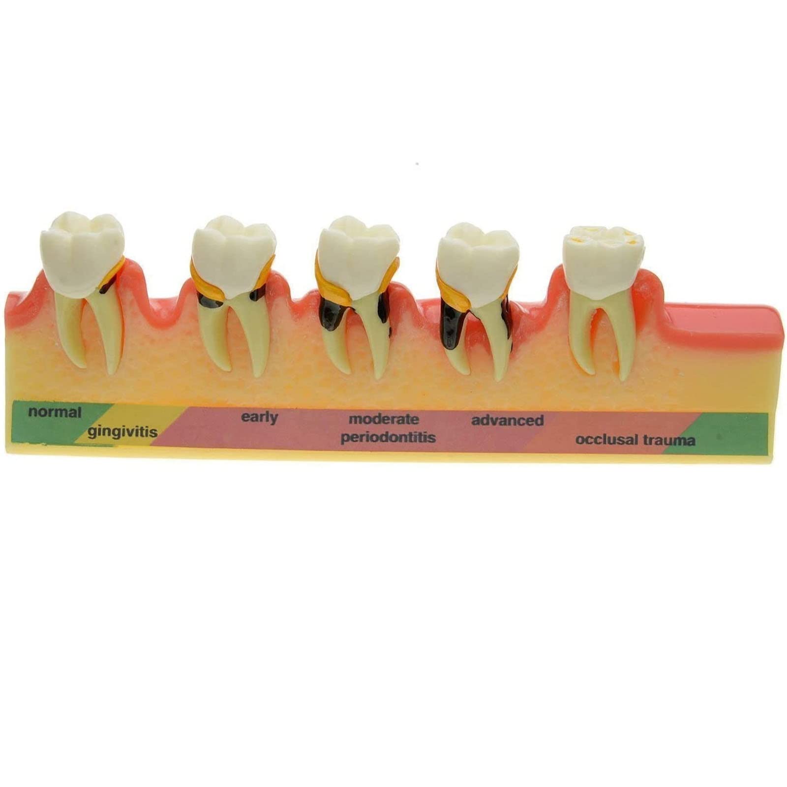 Model zmian przyzębia dentystycznego do nauczania, badania chorób przyzębia, rozwój próchnicy zębów i zębów narzędzie edukacyjne, realistyczna anatomia dla uczniów