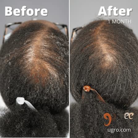 Miniatura 4 de Dr.UGro Gashee Suplemento para el crecimiento del cabello para hombres y mujeres vitaminas para el cabello más grueso y fuerte. Promueve el