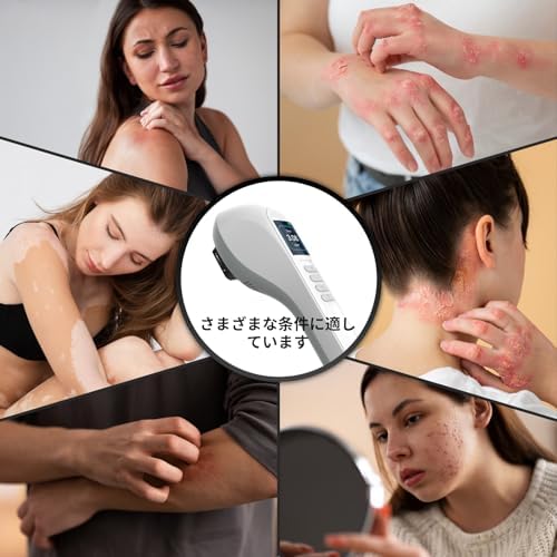 Amazon.co.jp: エキシマライト ナローバンド 光線 308ナローバンド