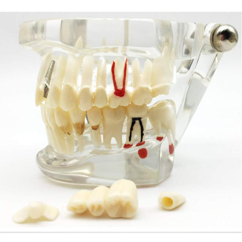 Model,Prosthetic Removable Implant Model for Demonstration and Patient and Student Education