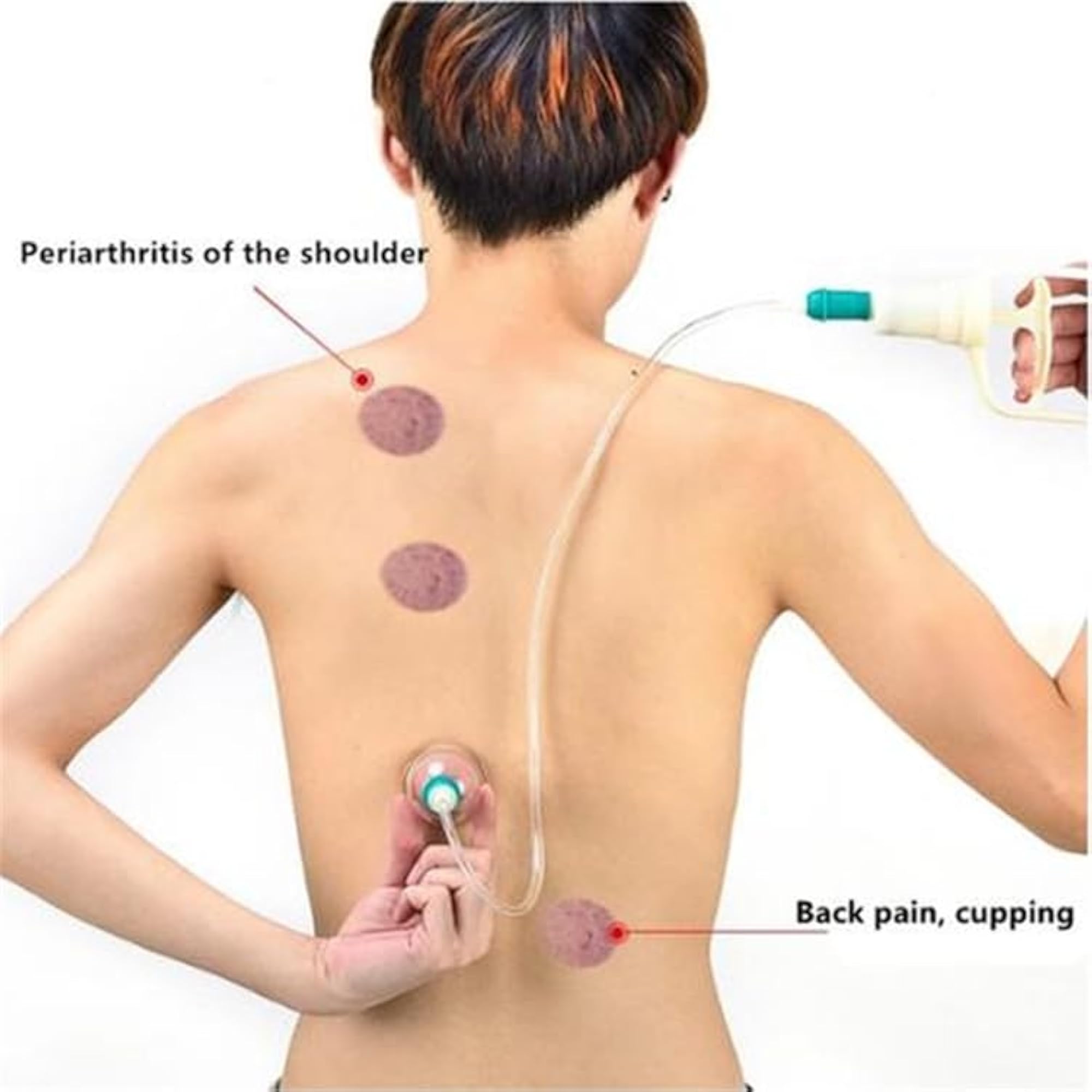 Vacuum Cupping Apparatus, Single Cupping Pump