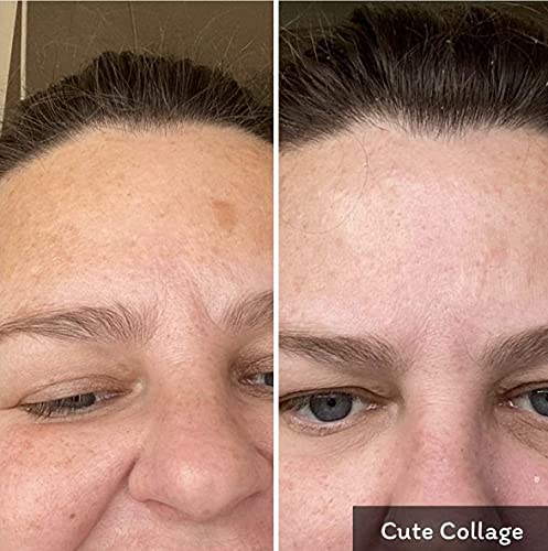 Dark Spot Corrector, Dark Spot Remover For Face, Melasma And Hyperpigmentation Treatment, Dark Spot Serum, Age Spot Remover, With Tyrostat, Kojic Acid, Alpha Arbutin, Mulberry Extract, Lactic Acid 1Oz #TOP5