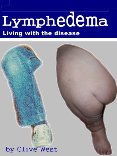 Lymphedema - Living with the disease