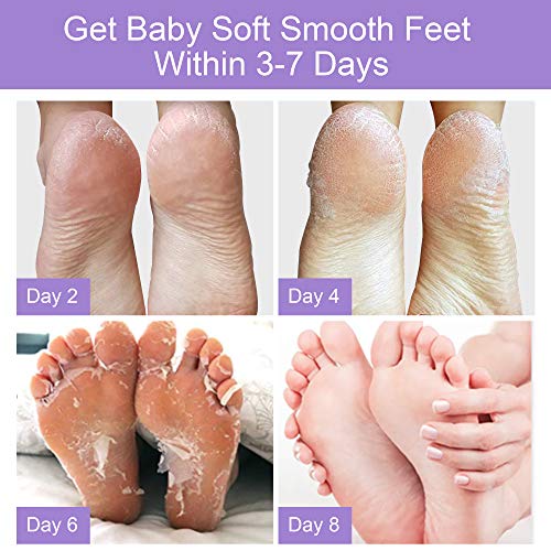 image for WOAYUS Foot Peel Mask, 2 Pack Exfoliating Foot Peeling Spa Masks for D