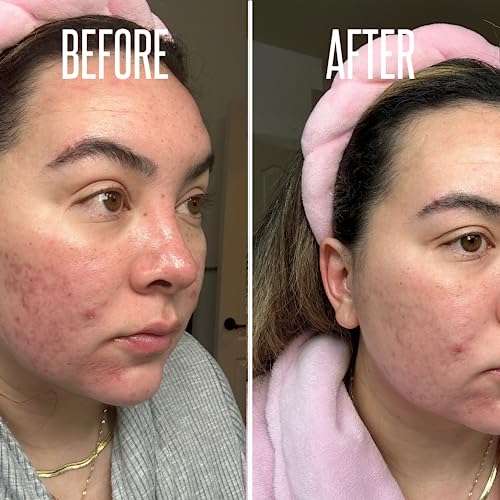 Glycolic Acid Pads, Chemical Peel For Face At Home With 20% Glycolic Acid And Vitamin C - Exfoliating Face Pads, Glycolic Acid Peel For Face Exfoliating Pads -Face Cleansing Pads 50 Cotton Facial Pads #TOP3