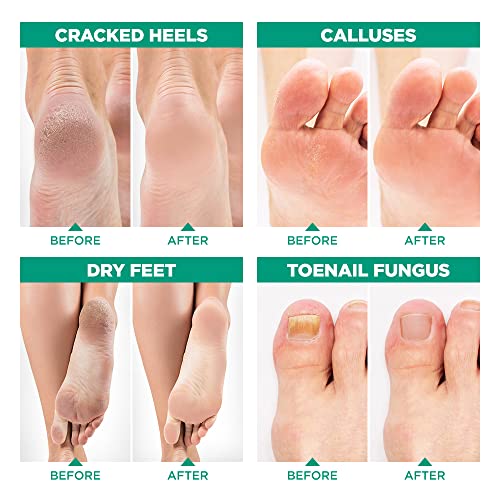 Tea Tree Oil Foot Soak With Epsom Salt - Made In Usa - For Toenail Fungus, Athletes Foot, Stubborn Foot Odor Scent, Fungal, Softens Calluses & Soothes Sore Tired Feet - 1 Lb #TOP5