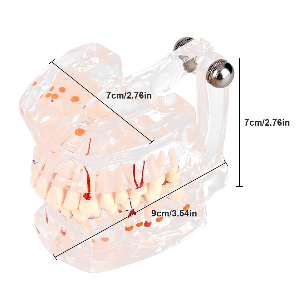 Walfront Modèle de Dents Amovibles, Transparent Dentaire Implant Disease Enseignement Étude Standard Dents Modèle Démonstration Pathologique