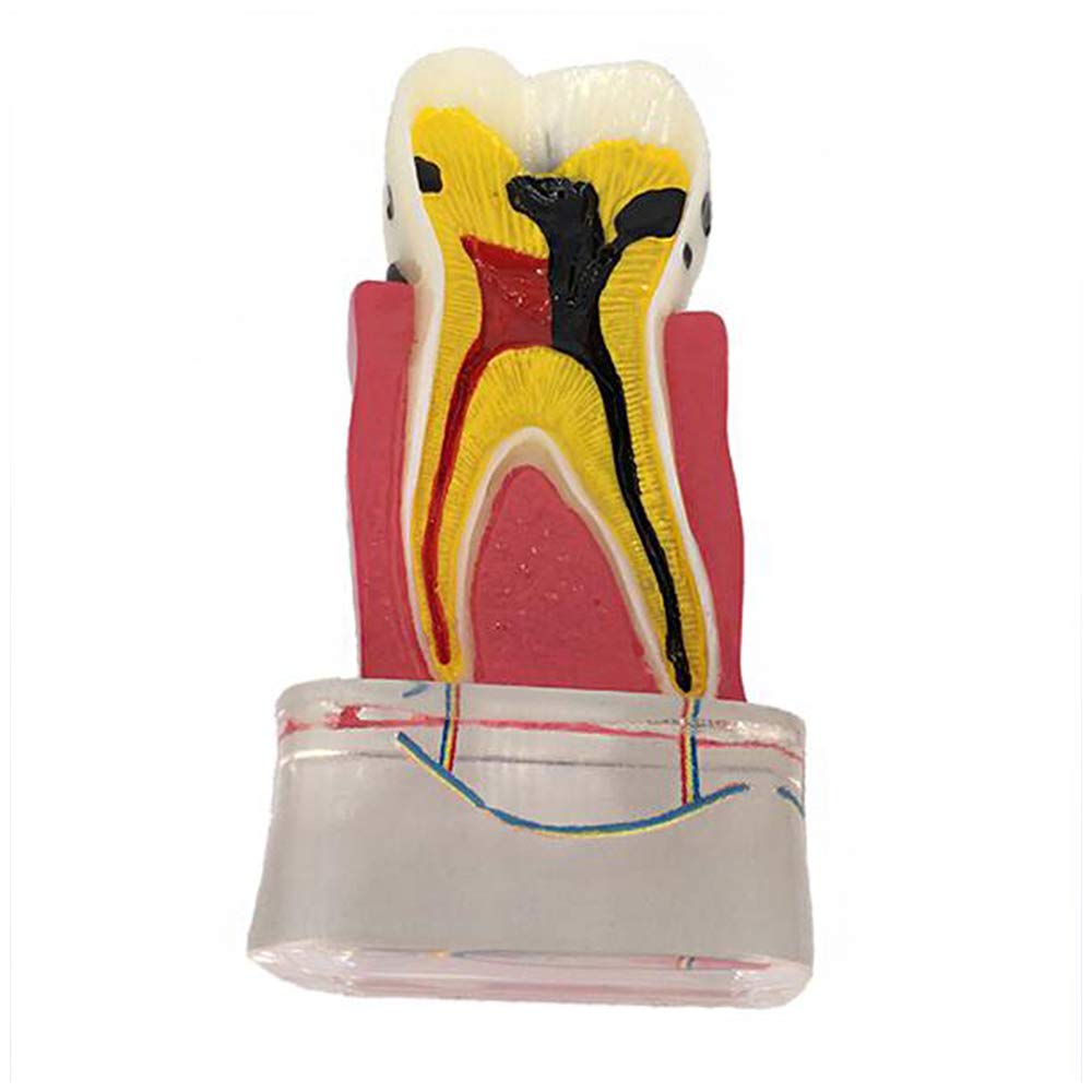 Modèle D'Implant Dentaire – Modèle Anatomique des Dents – Modèle D'Étude des Soins Dentaires – Modèle De Dent De Démonstration en Coupe Transversale