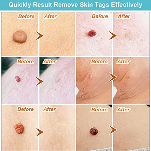 116 Stck Skin Tag Removal Patch Kit, Stielwarzen Entfernen schnell Entfernen Schnell Kit fr Gesicht, Hals und Krper - Image 4