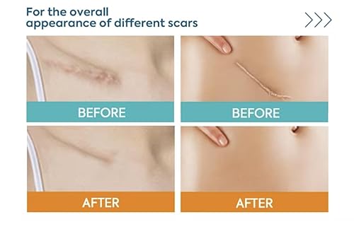 Miniatura 2 de Hojas de silicona para cicatrices de 1.6 x 120 pulgadas, grado médico, de larga duración, rollo de cinta reutilizable para cesárea, cicatrices