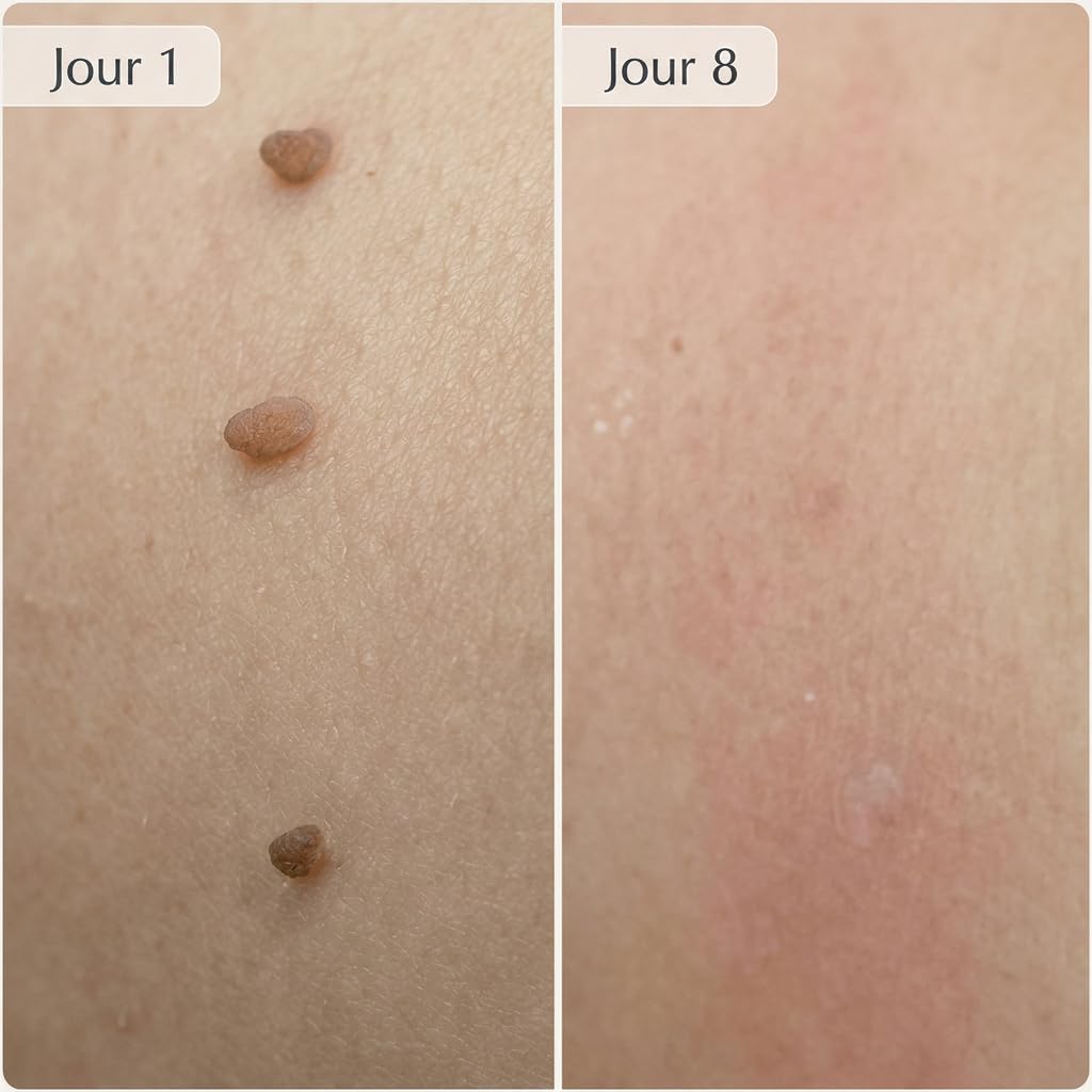 DermaSkin Pro Dermaskin Pro Acrochordon Traitement Efficace Solution Rapide Pour Éliminer Acrochordons Sans Cicatrice À La Maison (Bleu 1 ensemble)