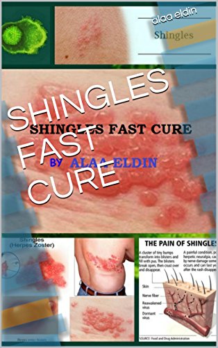 SHINGLES FAST CURE