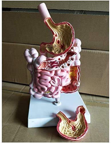ERNZI Modelli di Materiali Educativi, Modello Educativo Modello di Malattia del Sistema Digerente - Modello di Organo Modello Umano