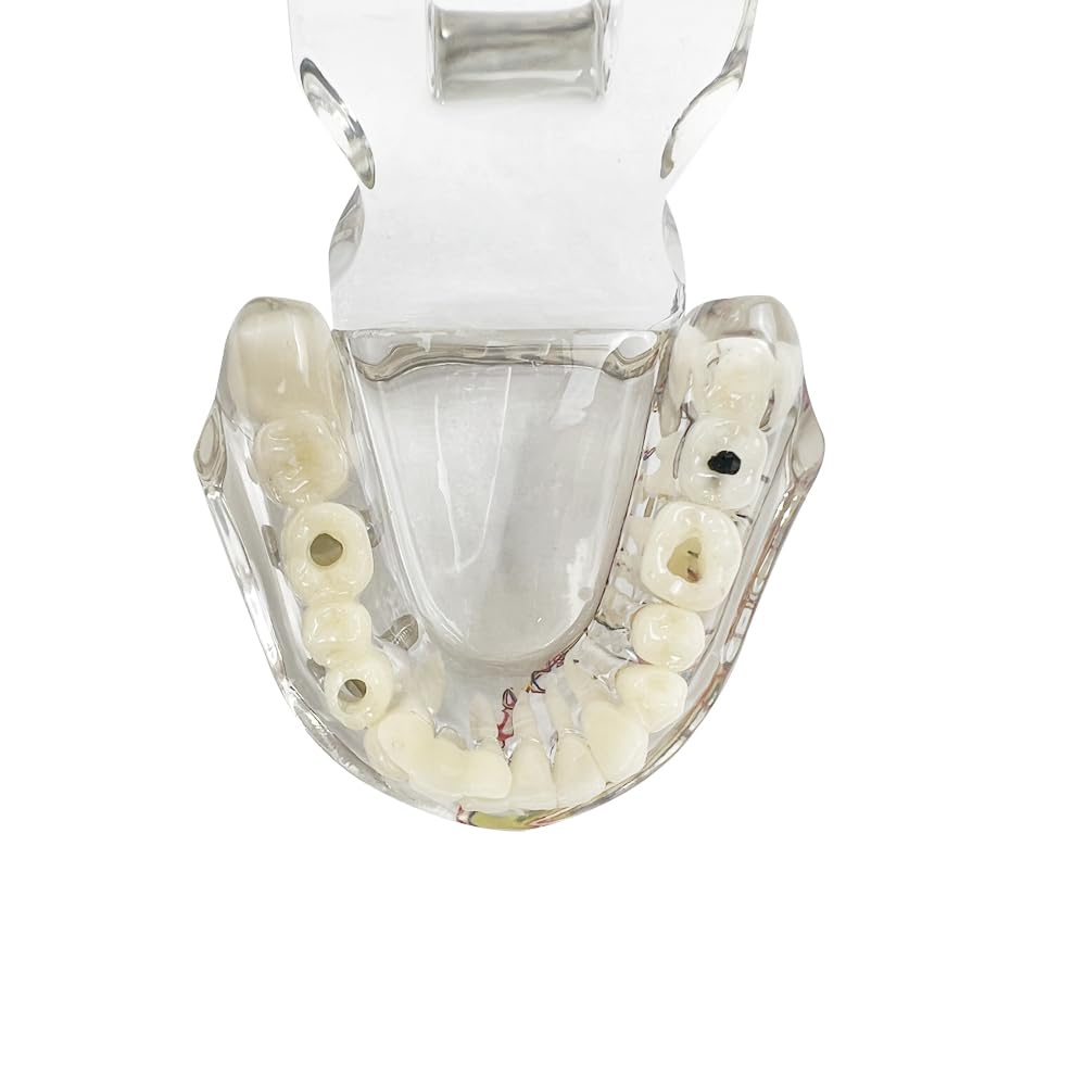 Modello dentale di riparazione neurale Modello dentale Malattia dell'impianto Modello dei denti Dentista Modello di insegnamento patologico standard dei denti rimovibili