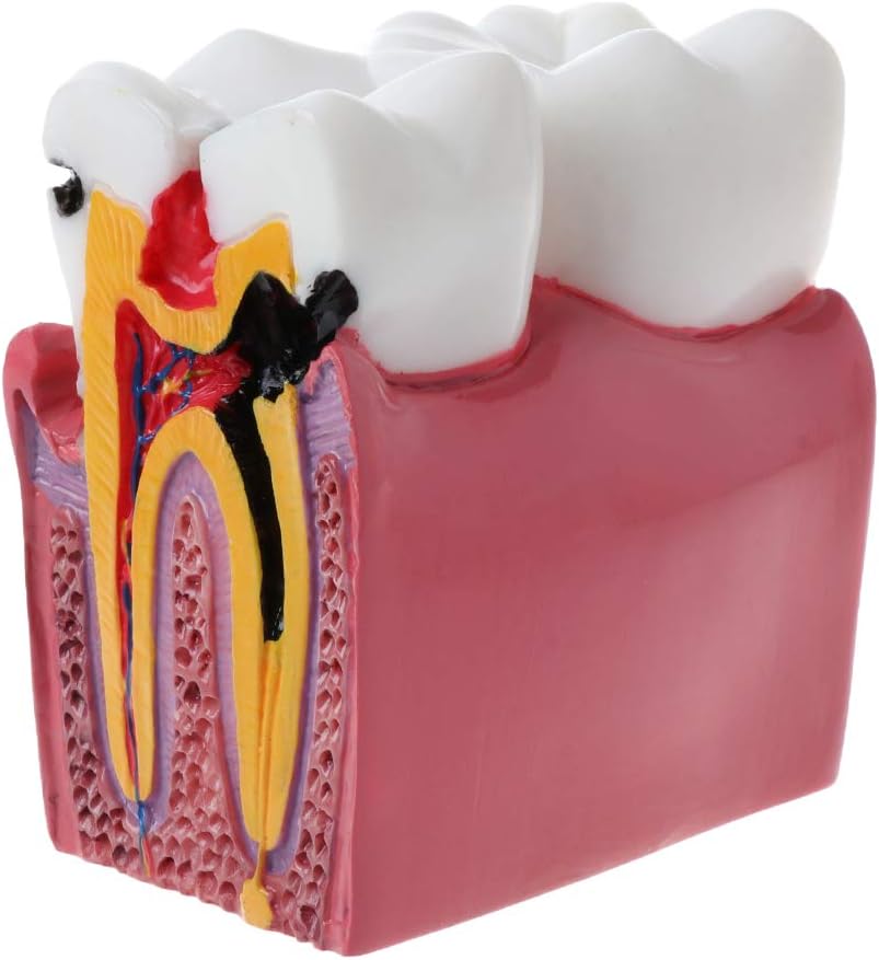 Caries Comparation Anatomy Teeth Model for Dental Anatomy Lab