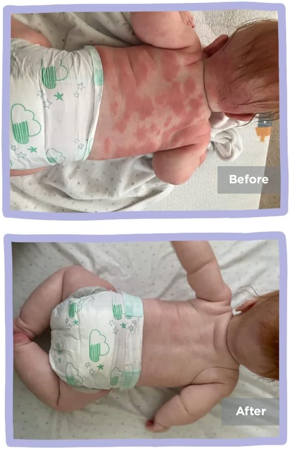 Eczema Clothing Starter Pack 1 for Baby Helps Moisturise Dry & Irritated Skin, Reduces Itching, Unisex Skincare Clothing Eczema Clothing Starter Pack 1 for Baby Helps Moisturise Dry & Irritated Skin, Reduces Itching, Unisex Skincare Clothing