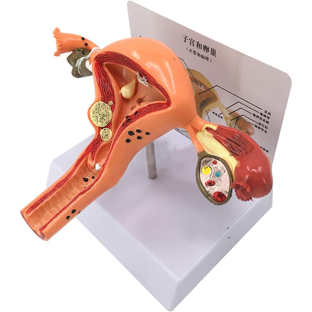 Human Female Uterus Model, Pathological Uterine Reproductive Model, Female Pathological Uterus Teaching Model, Ovarian Genitalia Anatomy Model Gynecology Model, for Doctors Study Uterus and Ovaries