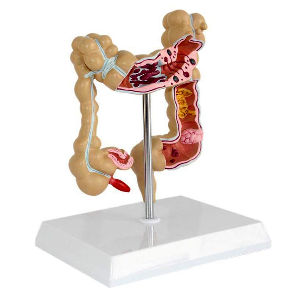 ERNZI Colorectal Lesion Model, Human Colonic Pathological Bowel Disease Model, Medical Anatomy, Teaching Tools