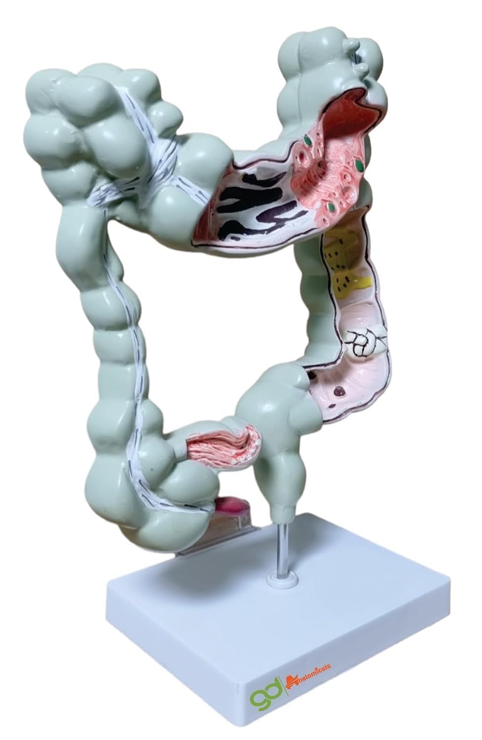 Large Intestine Model With Diseases Anatomystuffcouk Intestinal