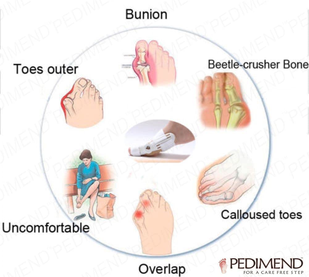 Orthopädische Hallux Valgus Schiene 1 PC von pedimendtm, Hallux Valgus Korrektur Zehen, sanft zu Ihrer natürlichen Position, für Männer und Frauen, eine Größe passend für die meisten, Foot Care