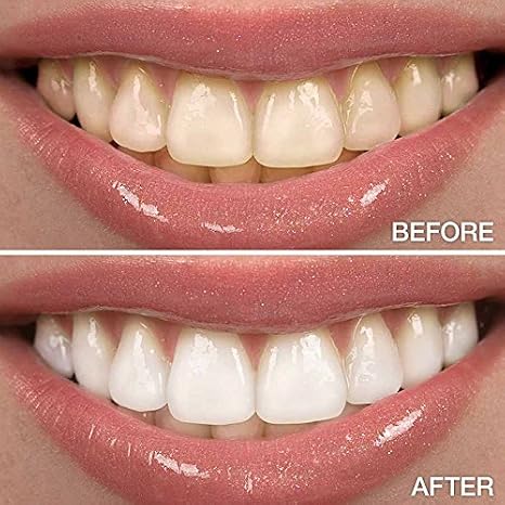 Novashine Professional Teeth Whitening Kit Couples Bundle Advanced LED Light Fast Results Bundle for Two