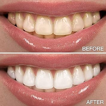 Novashine Professional Teeth Whitening Kit Couples Bundle Advanced LED Light Fast Results Bundle for Two