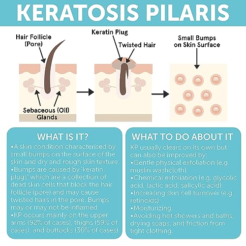 Keratosis Pilaris Lotion with Glycolic Acid, AHA & BHA Exfoliating | Strawberry Legs, KP & Ingrown Hair Treatment | Bumpy Skin Body Lotion | Moisturizing Cream for Redness, Dry, Rough & Flakey Skin