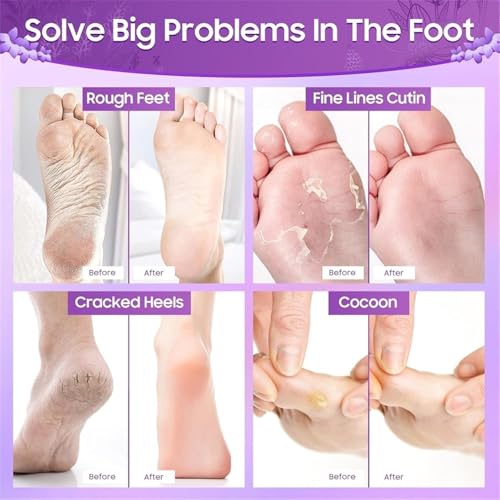 Vivue Foot Peel Mask for Women & Men, Peeling & Exfoliating Foot Mask for Dry Cracked Feet, Removes Dead Skin (Lavender) - Image 3 thumbnail