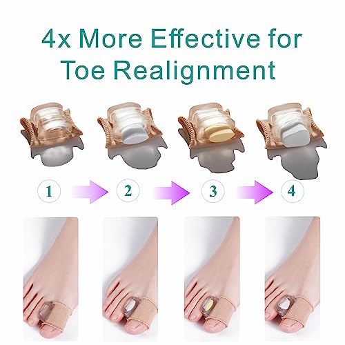 Ashomie All New Gel Toe Spacer Separator, 2 Pack Bunion Corrector For Overlapped Toes With 3 Adjustable Soft Toe Spacers For Bunion And Bunion Pain Relief Can Be Worn Shoes Size:5-11 #TOP2