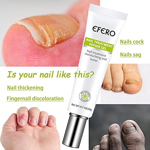 2Pcs Toe Be Health Instant Beauty Cream,Cure Damaged Foot & Toenails, Nail & Toenail Treatment Nail Repair Cream,Renews Yellow, Cracked And Split Nails #TOP3