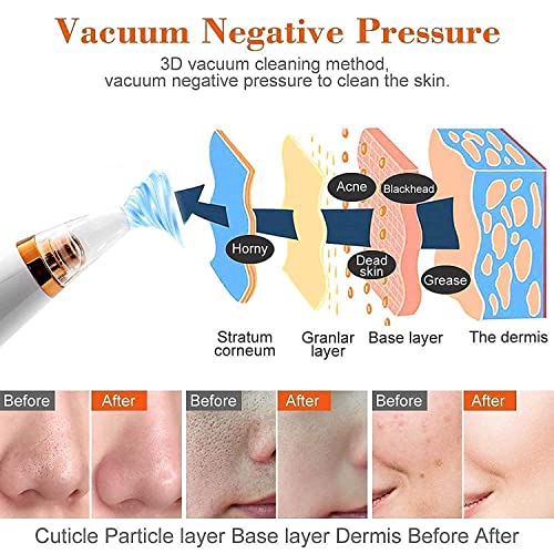 Image of IXWQ 6-in-1 Multifunction Blackhead Remover, Electric Derma Suction Machine, USB Rechargeable Acne Pimple Pore Cleaner Vacuum Tool, Facial Cleanser Whitehead Extractor Remover Device for Nose & Skin Care