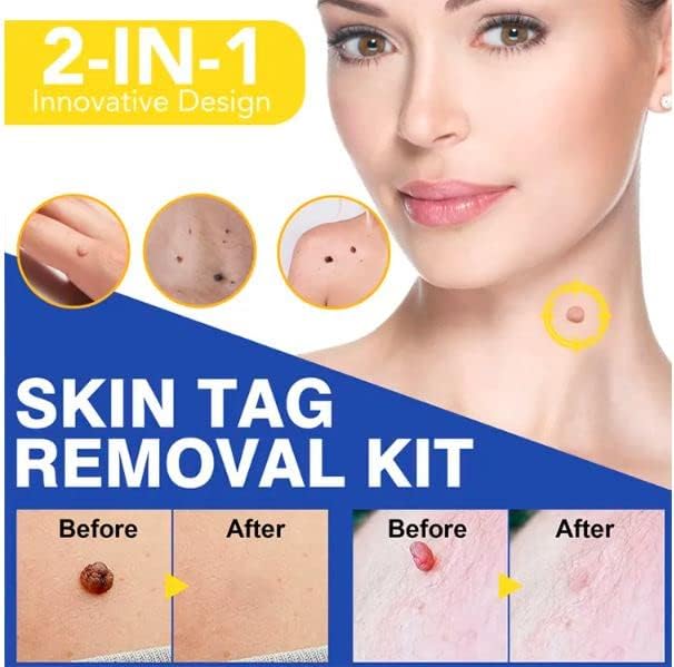 Image of Skin Tag Remover Set, Skin Tag Remover Kit 2 in 1, Skin Tag Removal Kit with Rubber Bands Rings for Removing Small to Medium