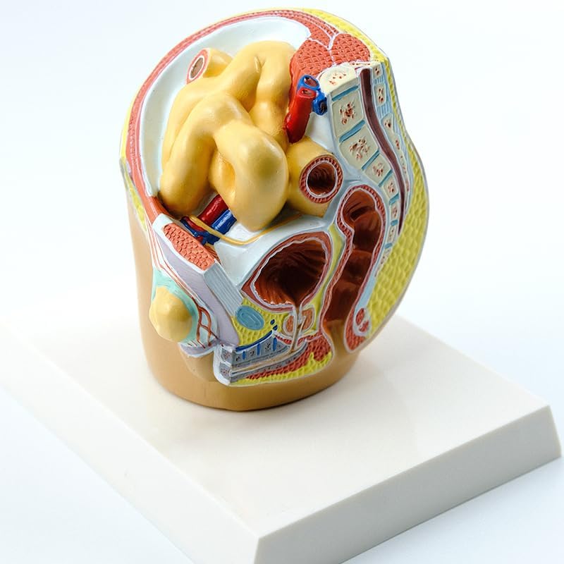Human Inguinal Hernia Demonstration Model - Anatomical Display for Medical Training and Health Education