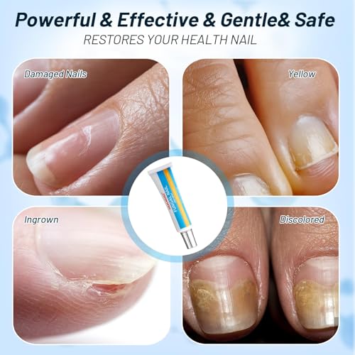 Image of Toenail Fungus Treatment Extra Strength, AntiFungal Ointment for Ingrown, Yellow, Discolored and Damaged Nails, Gentle & Effective.